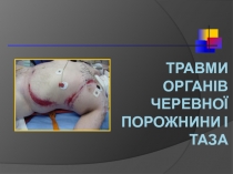 ТРАВМИ ОРГАНІВ ЧЕРЕВНОЇ ПОРОЖНИНИ І ТАЗА