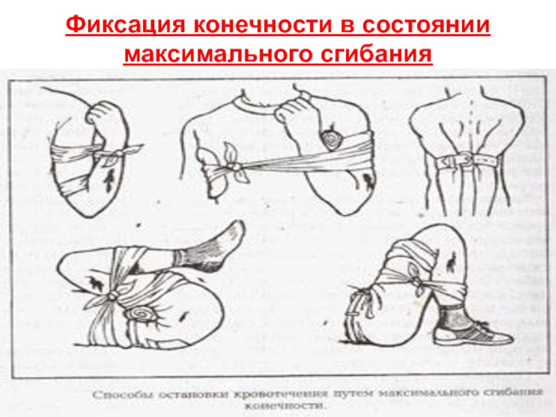 Травматическая ампутация голени карта вызова