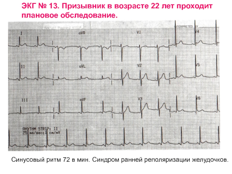 Синдром ранней реполяризации желудочков презентация