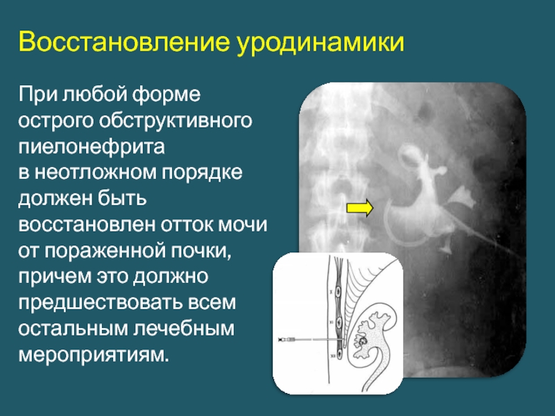 Пиелонефрит урология презентация