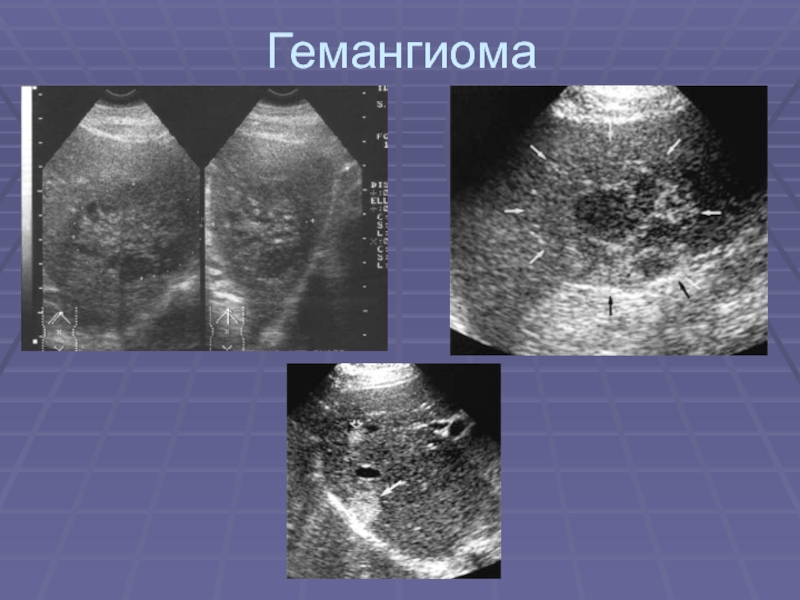 Метастазы в печени узи картина