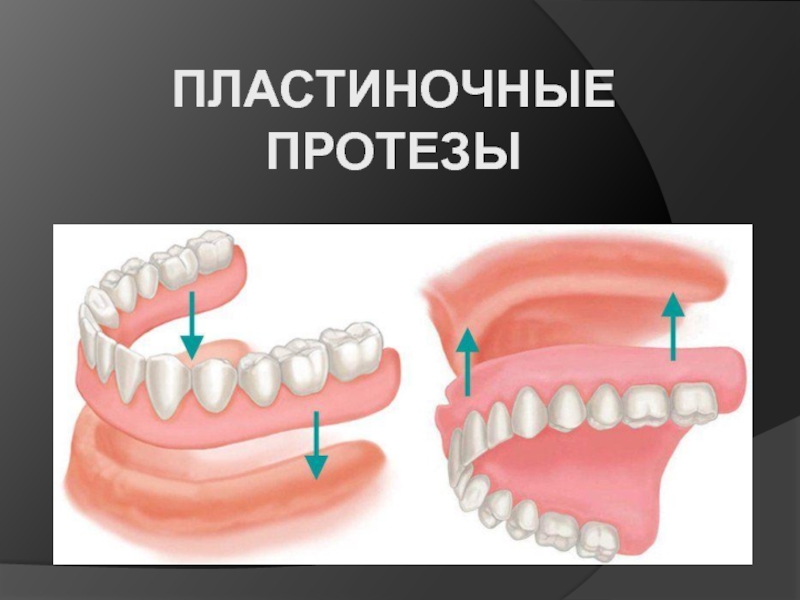 Презентация Пластиночные протезы