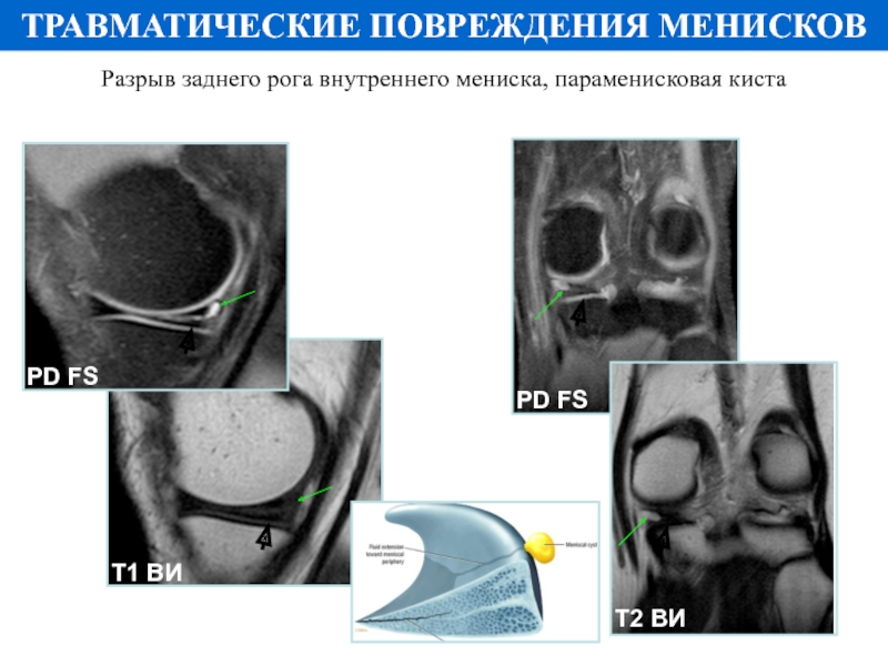 Повреждение заднего рога мениска. Параменисковая киста заднего рога. Киста мениска заднего рога.