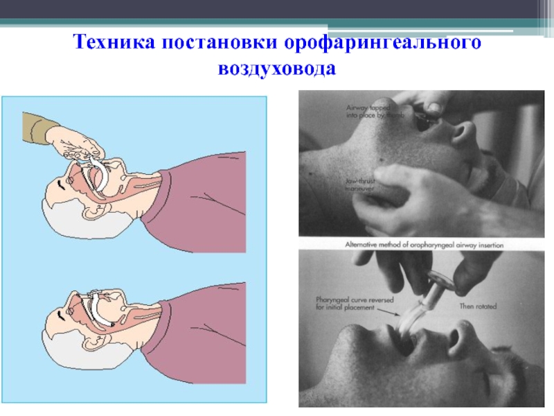 Постановка техники. Орофарингеальный воздуховод Гведела техника. Введение орофарингеального воздуховода. Техника введения воздуховода. Введение воздуховода при СЛР.