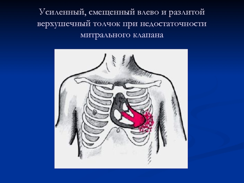 Аускультативная картина недостаточности митрального клапана