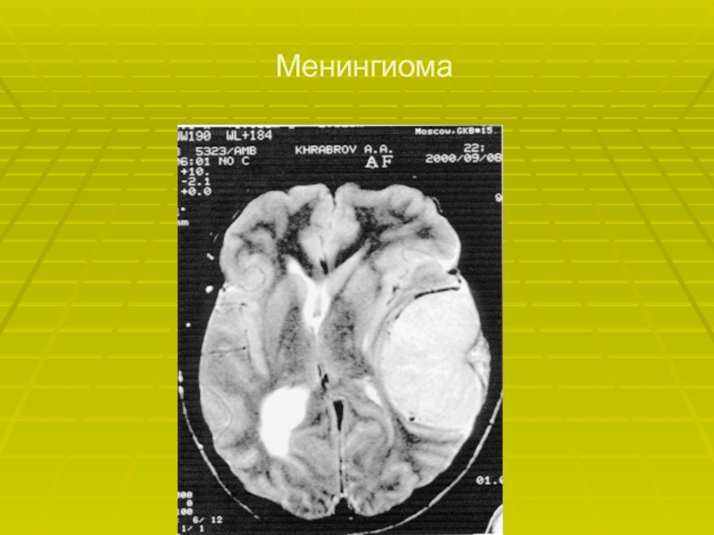 Менингиома головного мозга продолжительность операции