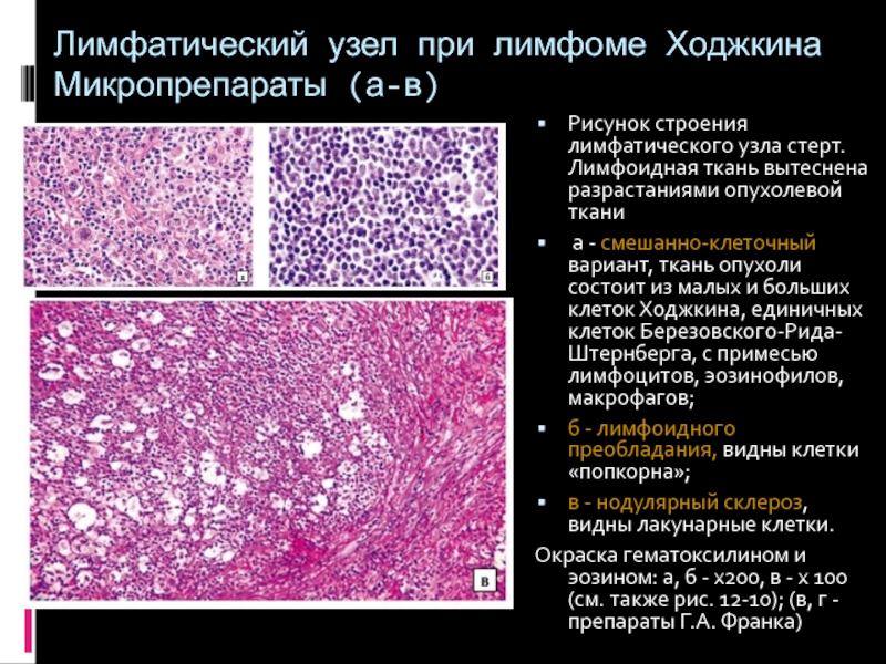 Презентация на тему лимфома