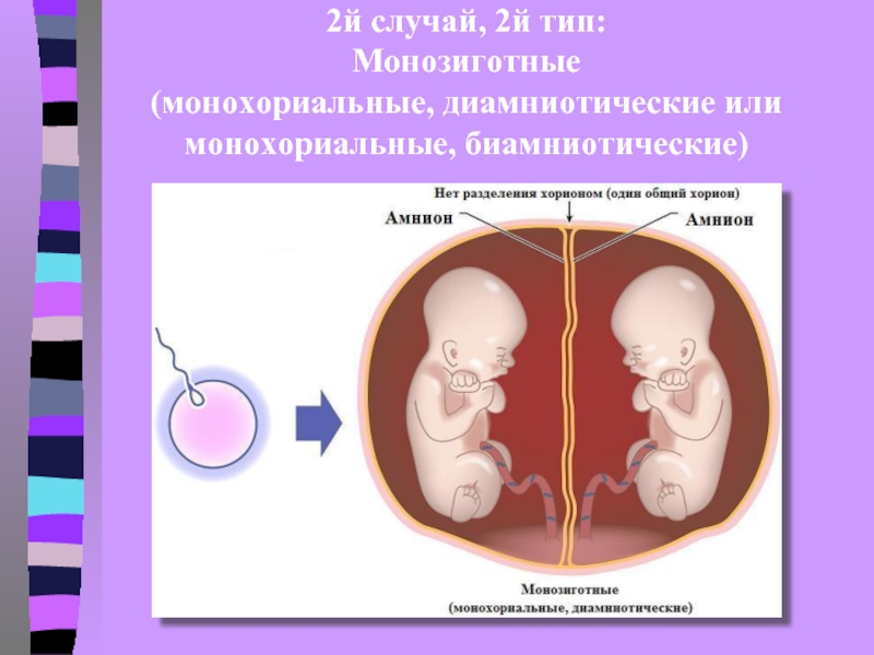 Монохориальная двойня. Монохориальная моноамниотическая. Монохориальные моноамниотические Близнецы. Двойняшки монохориальная диамниотическая. Монозиготная монохориальная двойня.