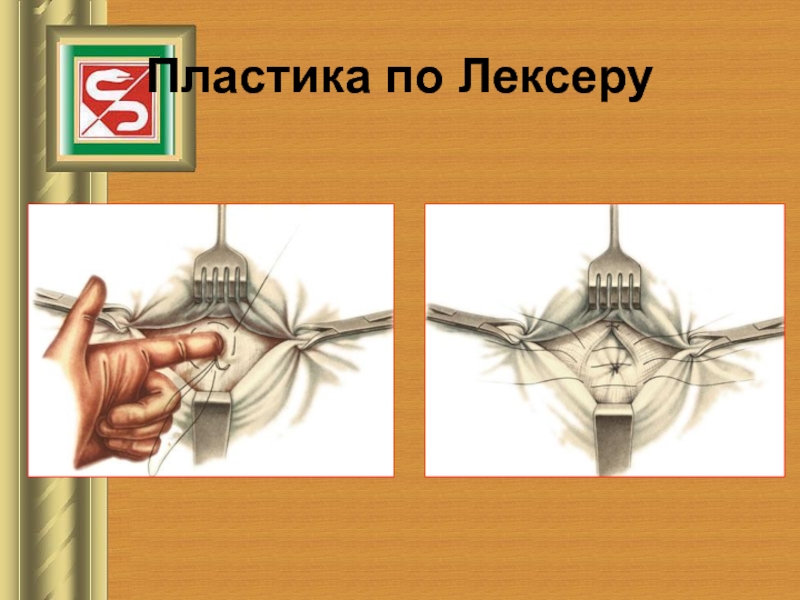 Пластика по мейо картинки