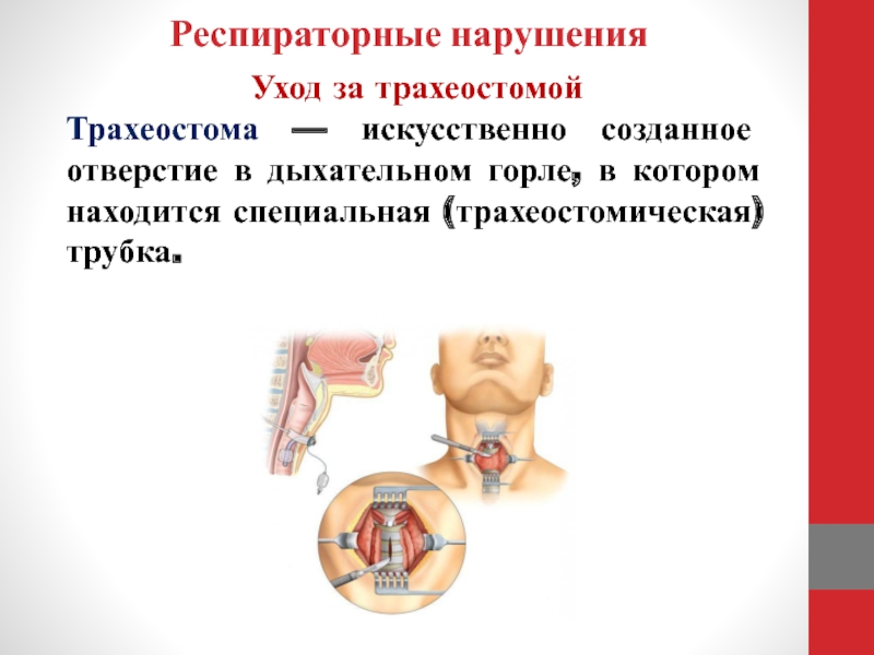 Несостоятельность трахеостомы карта вызова