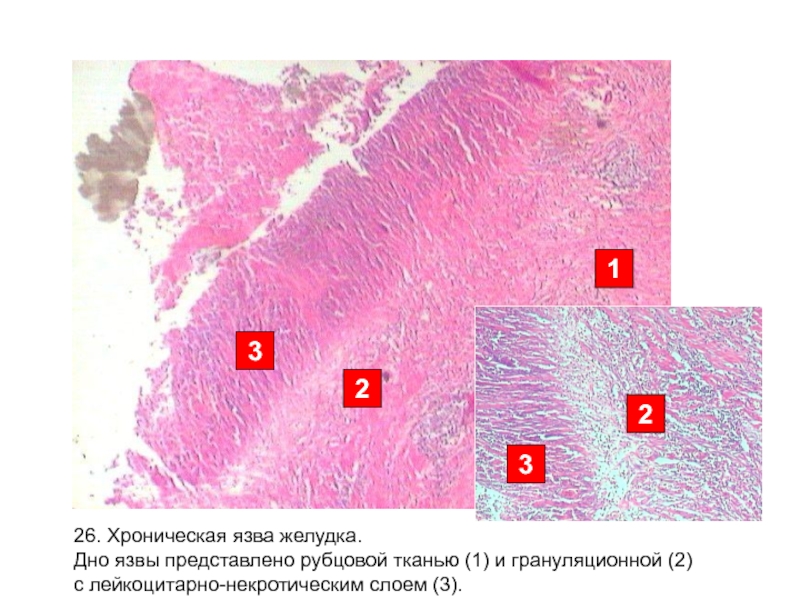 Хроническая язва желудка микропрепарат рисунок
