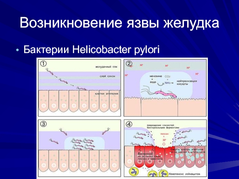 Возникновение язвы желудкаБактерии Helicobacter pylori