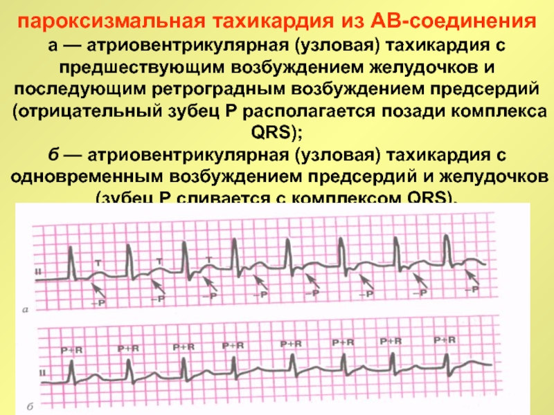 Пароксизмальная тахикардия презентация