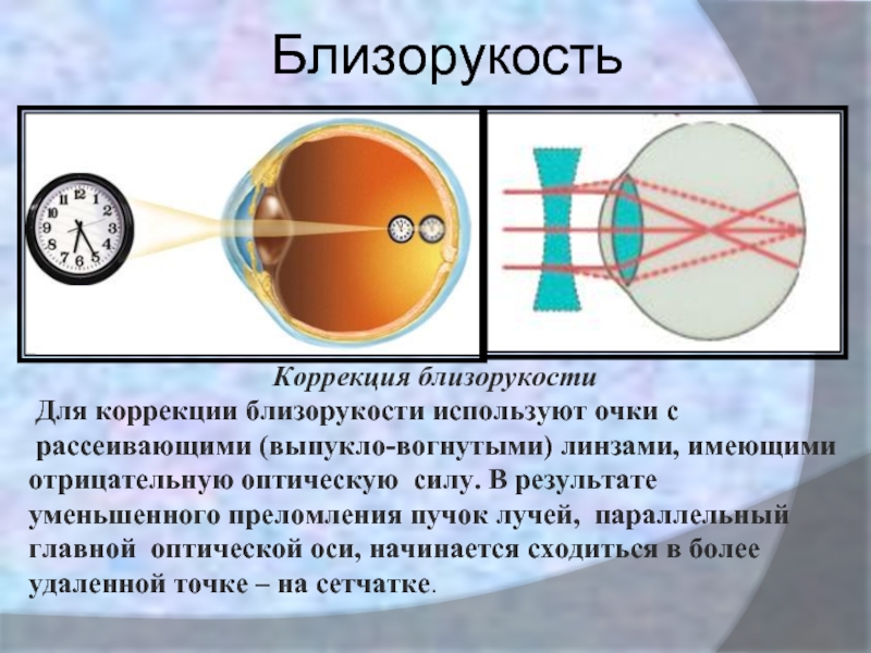 Коррекция зрения миопия. Линзы для коррекции миопии. Выпуклые линзы для близоруких. Близорукость. Рассеивающая линза для близорукости.