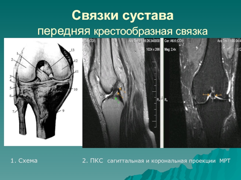 Картина разрыва пкс