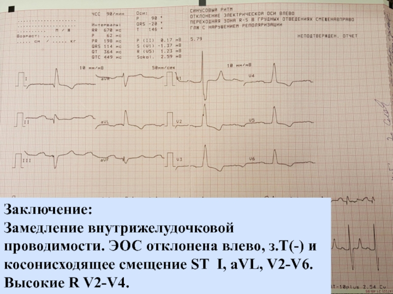 Замедление проводимости. ЭКГ смещение St вверх II v3,v4,v5. Заключение ЭКГ замедление внутрижелудочковой проводимости. ЭКГ неспецифическая внутрижелудочковая проводимость. V4 на ЭКГ смещение St на кардиограмме.