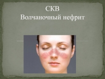 СКВ Волчаночный нефрит