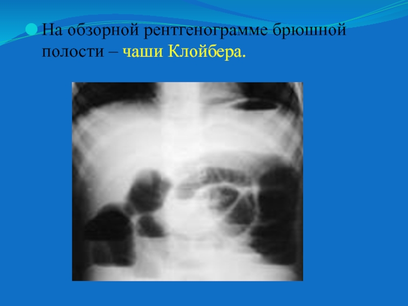 Обзорная рентгенография брюшной полости. Чаши Клойбера обзорная рентгенограмма. Чаши Клойбера на рентгенограмме характерны для. Чаши Клойбера на рентгенограмме брюшной полости. Рентген брюшной полости чаши Клойбера.
