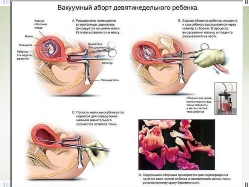 Всё о абортах…