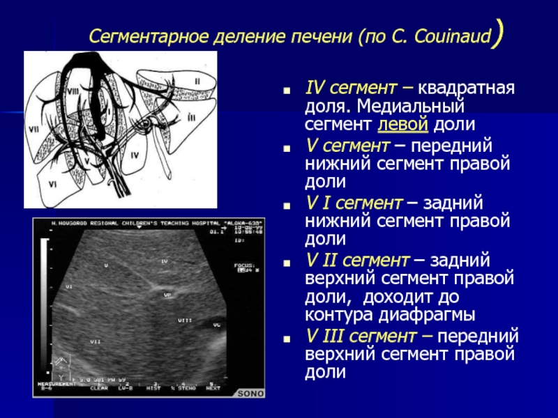 Сегменты печени на узи. Сегментарное деление печени. Медиальный сегмент левой доли печени.