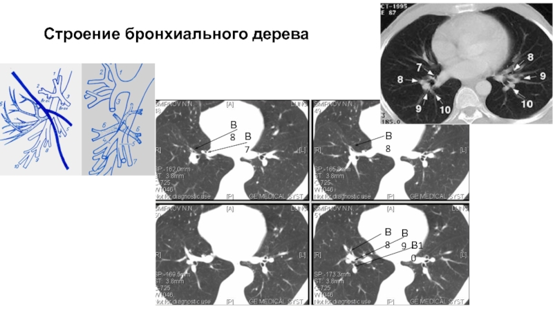 Итеративная реконструкция кт изображений