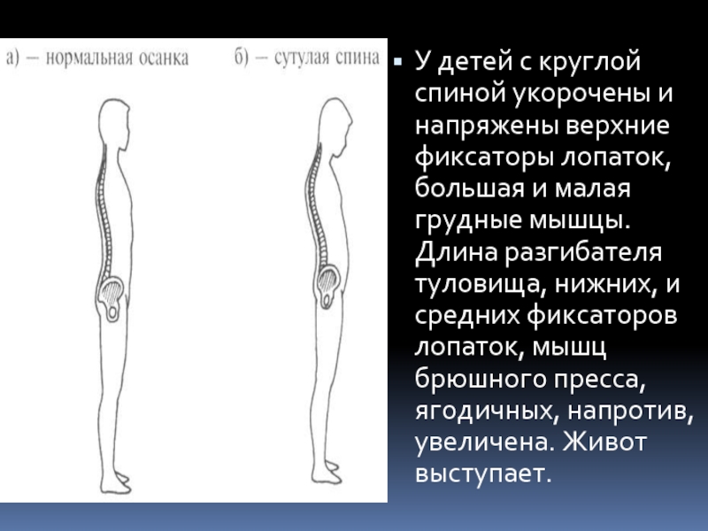 Плоская спина. Круглая спина у ребенка до года. Круглая спина у ребенка до года как выглядит.