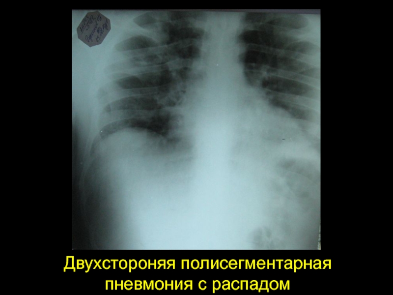 Полисегментарная пневмония. Полисегментарная двухсторонняя пневмония рентген. Полисегментарная пневмония s 10 s5. 2ст полисегментарная пневмония. Сливная полисегментарная пневмония двусторонняя.