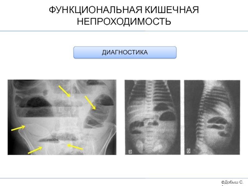 Приобретенная кишечная непроходимость