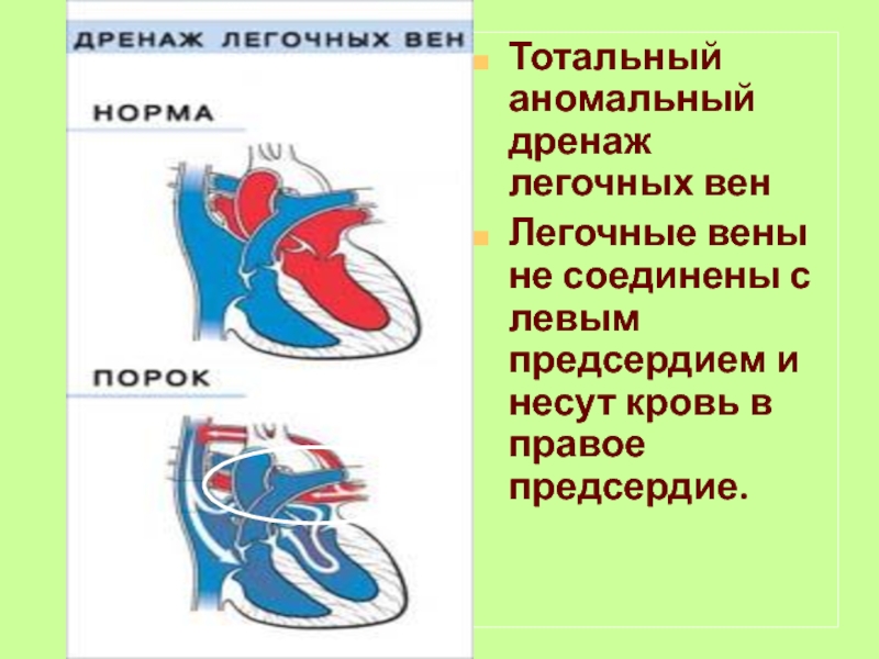 Частичный аномальный дренаж легочных вен