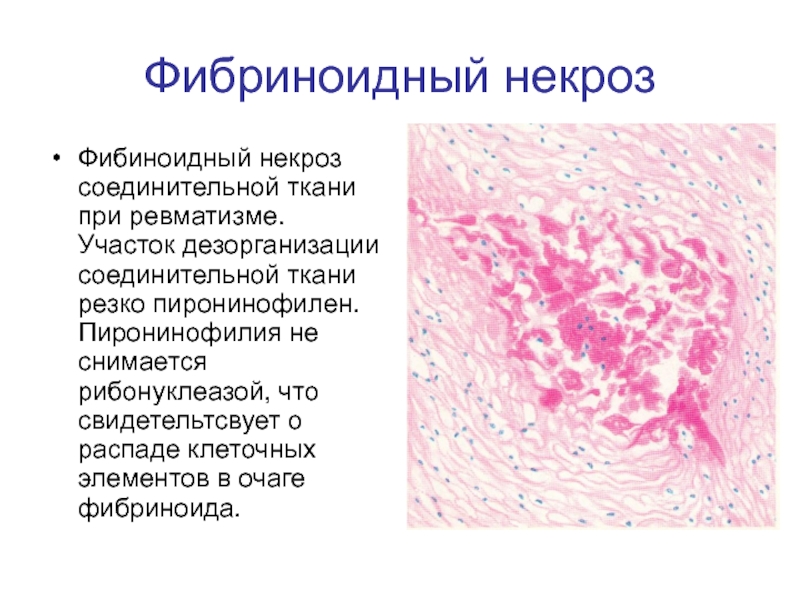 Фибриноидное набухание соед ткани. Фибриноидное набухание патанатомия. Фибриноидный некроз соединительной ткани. Фибриноидное набухание и некроз соединительной ткани.