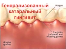 Генерализованный катаральный гингивит