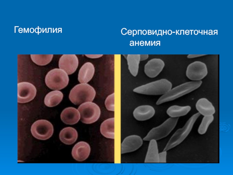 Серповидно клеточная анемия картинки