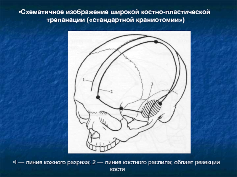 Костно пластическая трепанация черепа презентация