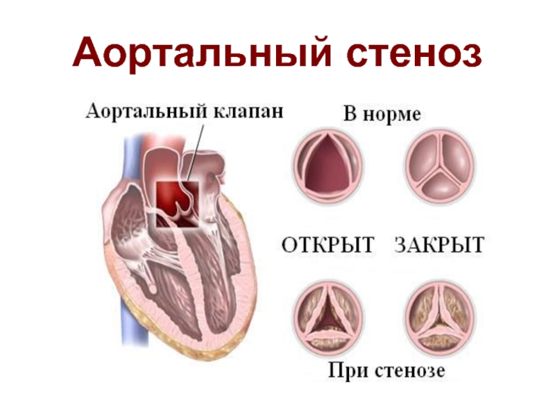 Аортальные пороки сердца презентация