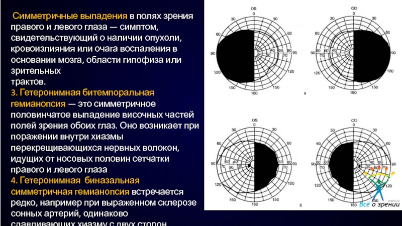 Как изменяется поле. Выпадение периферических полей зрения. Выпадение полей зрения снизу. ОНМК выпадение полей зрения. Секторообразное выпадение поля зрения.