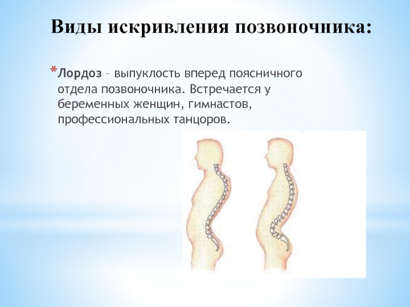 Что такое лордоз позвоночника поясничного отдела