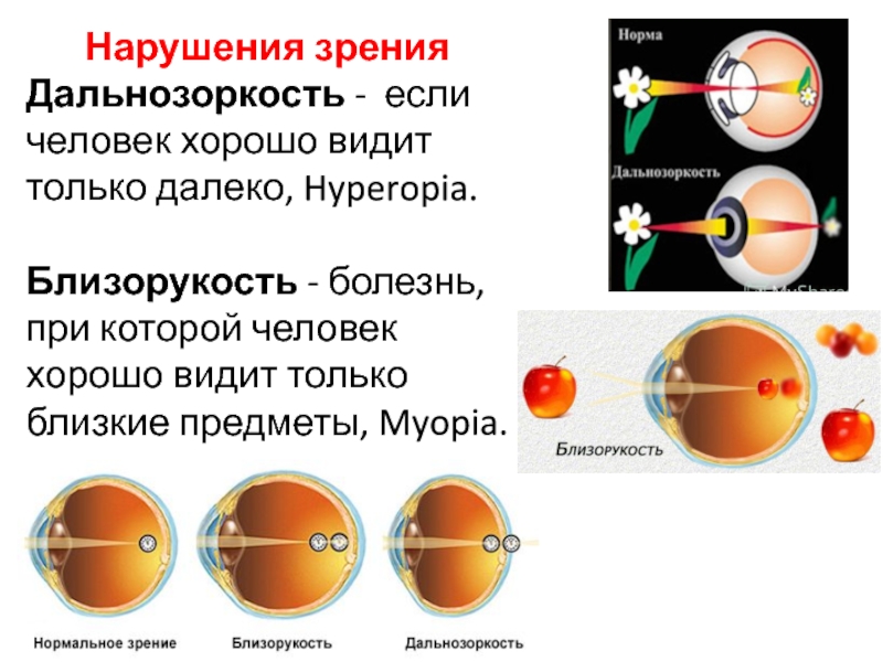 Дальнозоркость это когда. Нарушение зрения дальнозоркость. Нарушение зрения близорукость дальнозоркость. Заболевание миопия. Зрительный анализатор дальнозоркость и близорукость.