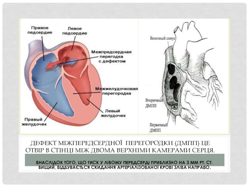 Дефект межпредсердной. Дефект межпредсердной перегородки классификация. Устранение дефекта межпредсердной перегородки. Патофизиология дефекта межпредсердной перегородки. ДМПП схема.