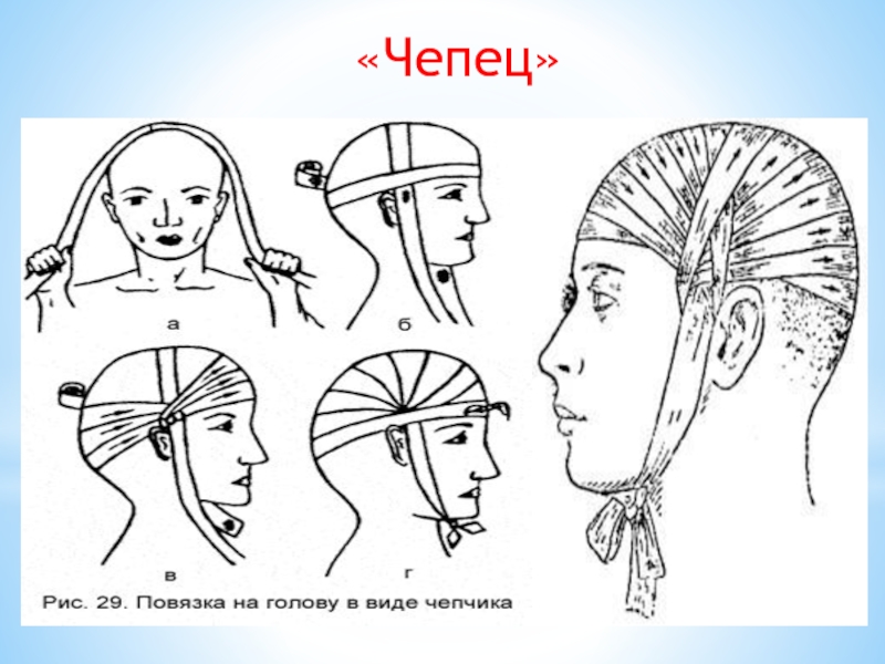 Перебинтовать голову схема