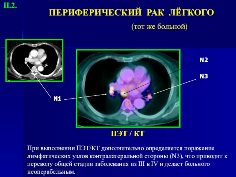 Как выглядит периферический рак легкого на компьютерной томографии