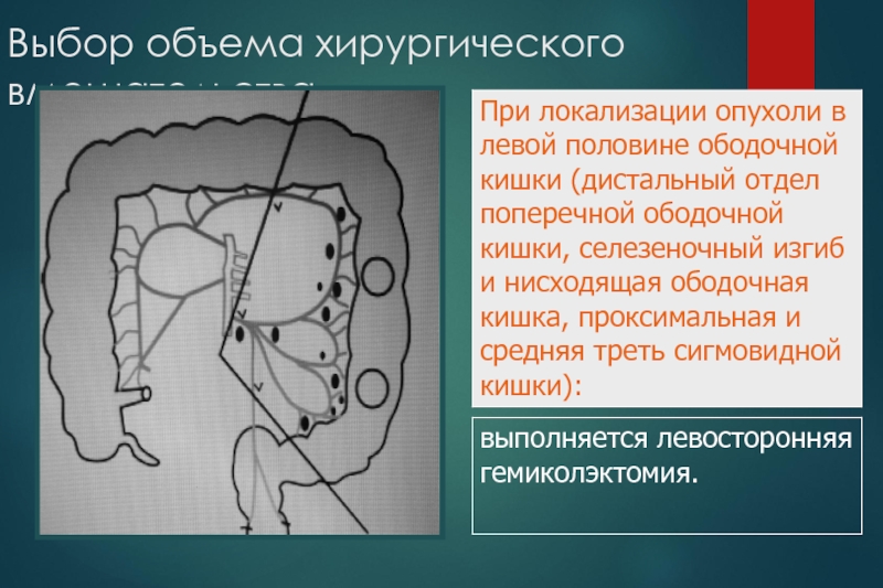 Рак ободочной кишки презентация