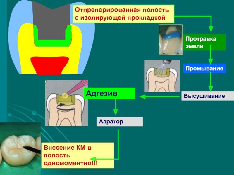 Лечебные и изолирующие прокладки в стоматологии презентация