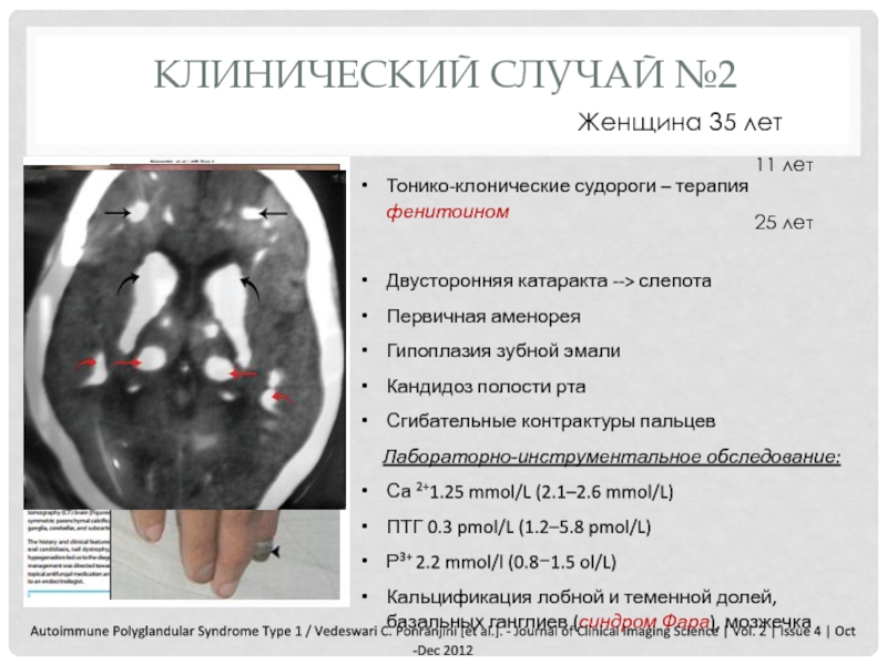 Аутоиммунные полигландулярные синдромы презентация