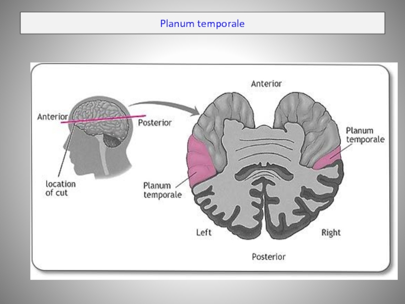 Planum temporale перевод. Planum temporale череп. Темпорале. Planum temporale анатомия. Планум темпорале.