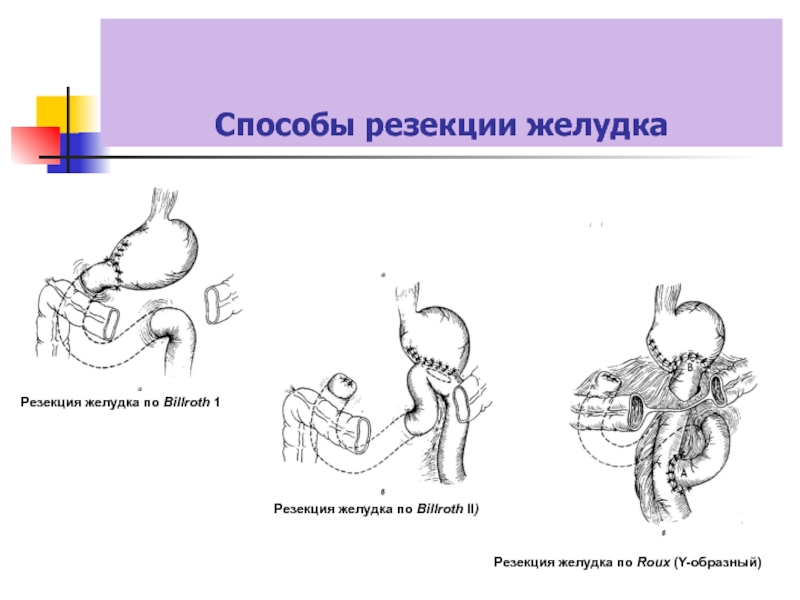 Резекция желудка по витебскому схема операции