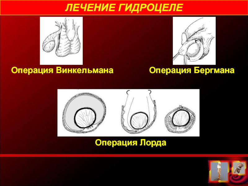 Гидроцеле. Операция Бергмана гидроцеле. Операция Винкельмана ход. Протокол операции Винкельмана.