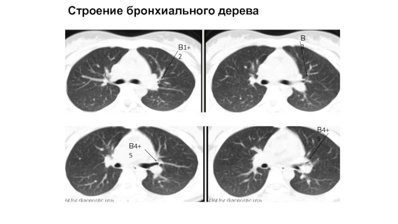 Бронхи на кт схема