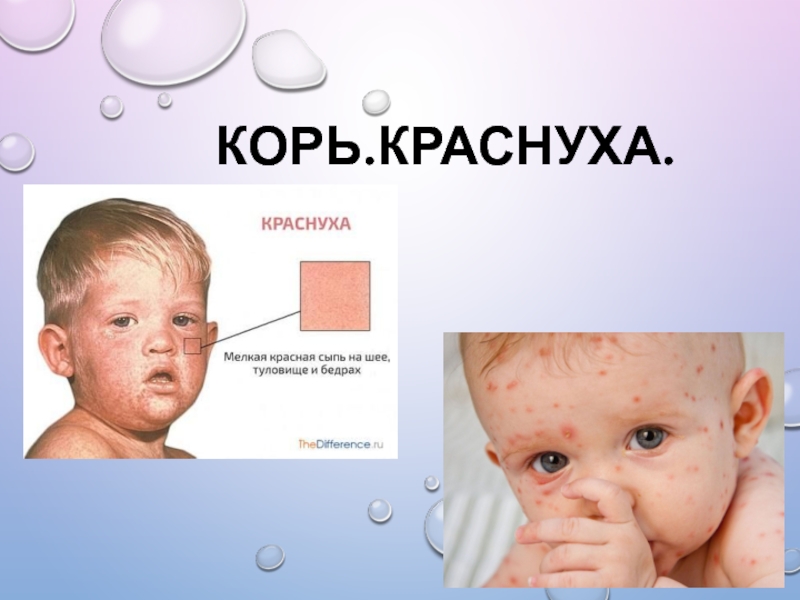 Корь.Краснуха