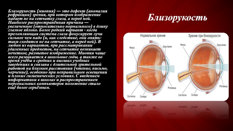 Презентация по теме миопия