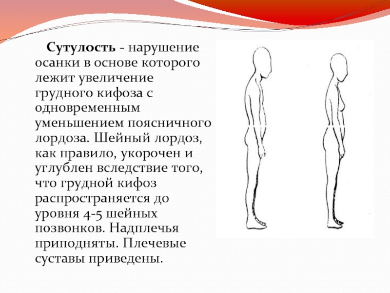 Сутулость. Нарушение осанки лордоз. Виды сутулости. Признаки сутулости. Основы нарушения осанки это.